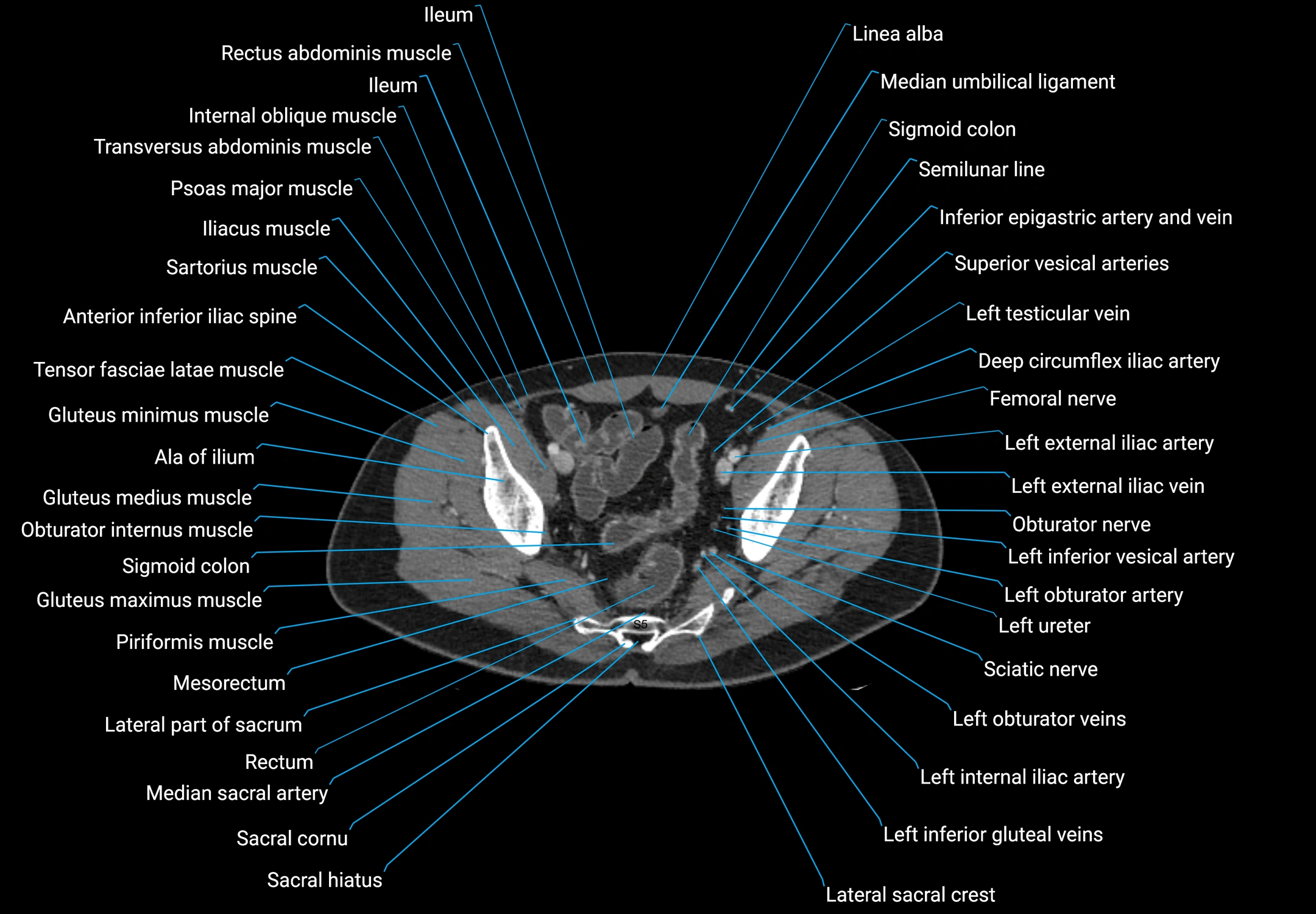 CT male pelvis axial cross sectional anatomy labelled radiology image -00169.webp